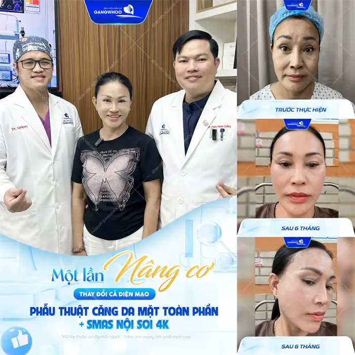 1 lần nâng cơ thay đổi diện cả gương mặt sau phẫu thuật căng da mặt toàn phần Smas nội soi 4K