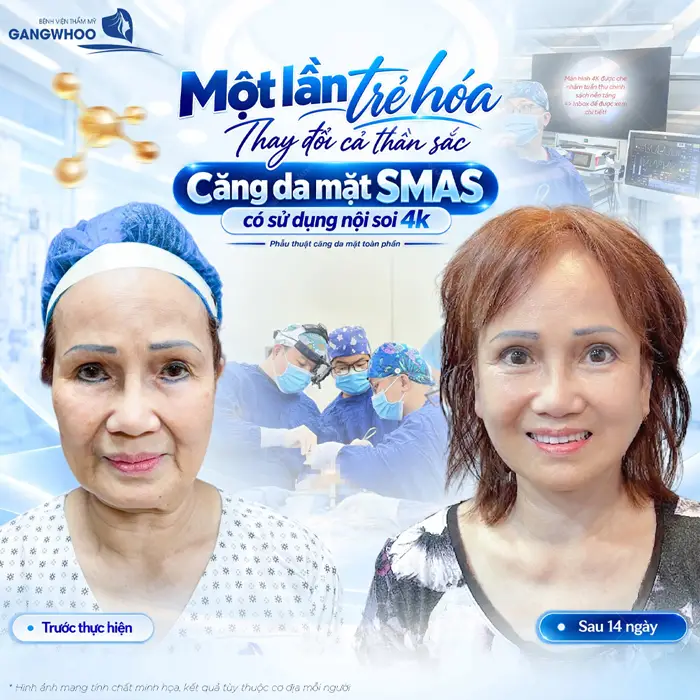 1 lần trẻ hóa thay đổi thần sắc ở tuổi trung niên sau thực hiện căng da mặt Smas có sử dụng nội soi 4K