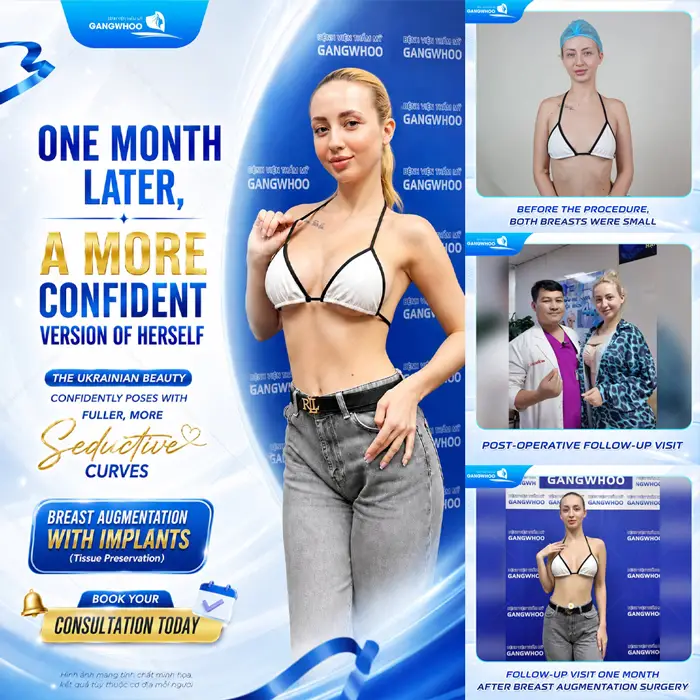 Kết quả sau 1 tháng nâng cấp vòng 1 tại Gangwhoo khách nước ngoài tự tin rạng rỡ với thần thái sexy mới