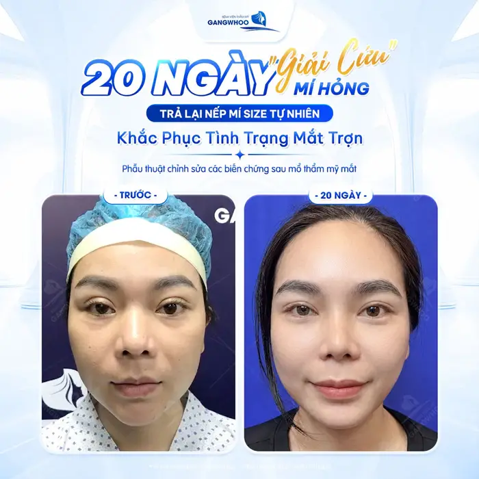 20 ngày giải cứu mí hỏng trả lai nếp mí đẹp tự nhiên, hài hòa và thêm cân đối