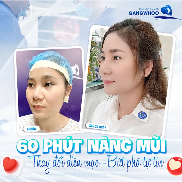 60 phút nâng mũi thay đổi diện mạo bứt phá tự tin diện mạo xuất sắc sau 30 ngày