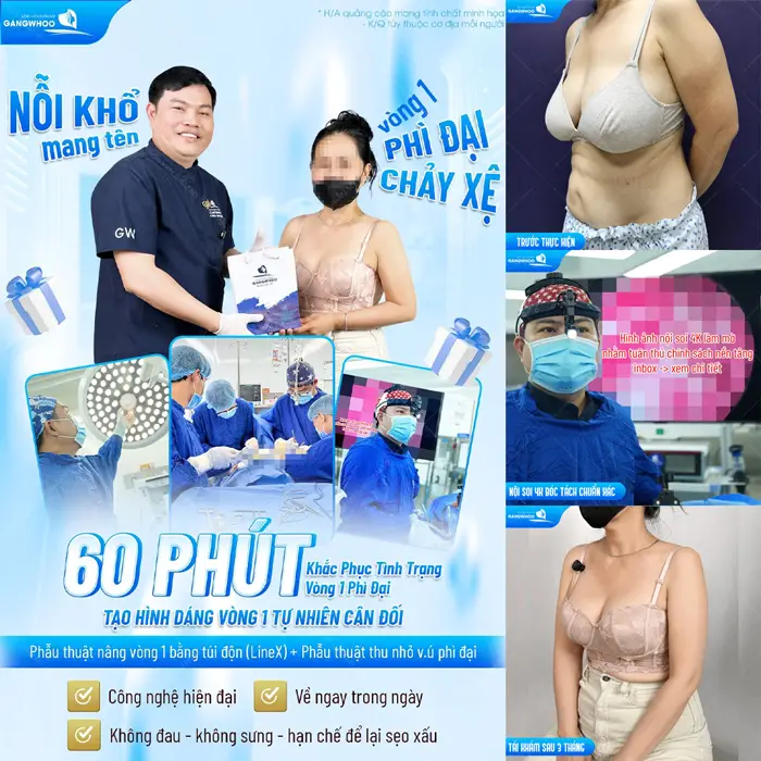 Phẫu Thuật Treo Vú Sa Trễ (Treo Ngực Sa Trễ) Nội Soi 4K Khắc Phục Mọi Cấp Độ Sa Trễ 8 Vòng 1 phì đại chảy xệ không còn là nỗi ám ảnh sau 60 phút đã tạo hình lại dáng vòng 1 đẹp tự nhiên và cân đối hơn
