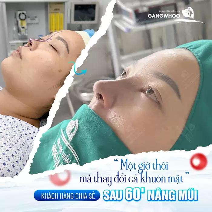 Nâng mũi thay đổi cả gương mặt, diện mạo cân trọn cả góc nghiêng