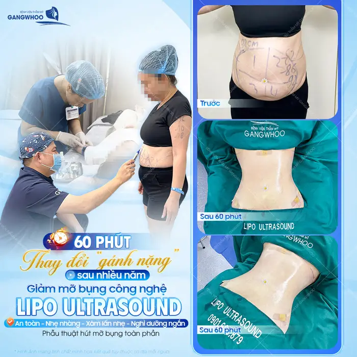 60 phút thay đổi gánh nặng sau nhiều năm giảm mỡ bụng công nghệ Lipo Ultrasound an toàn - nhẹ nhàng và hiệu quả nhanh