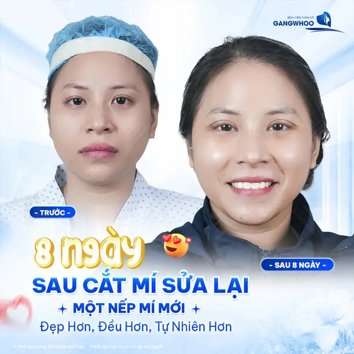 8 ngày sau cắt mí sửa lại 1 nếp mí mới gương mặt đẹp hơn, đều hơn và tự nhiên hơn