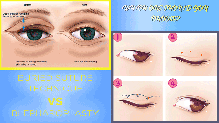The Differences Between Buried Suture and Blepharoplasty