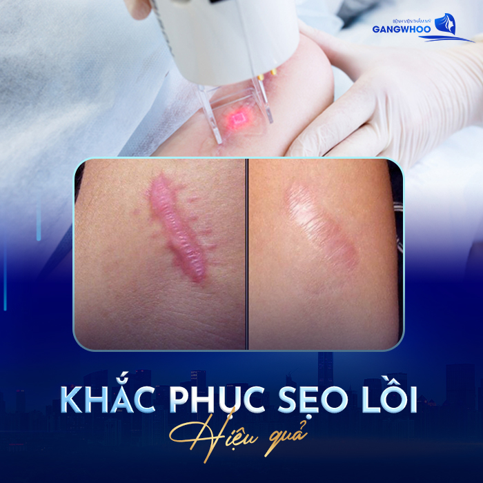 有效的瘢痕疙瘩治疗方法:“修复瘢痕疙瘩高达90%” 5 Điều Trị Sẹo Lồi