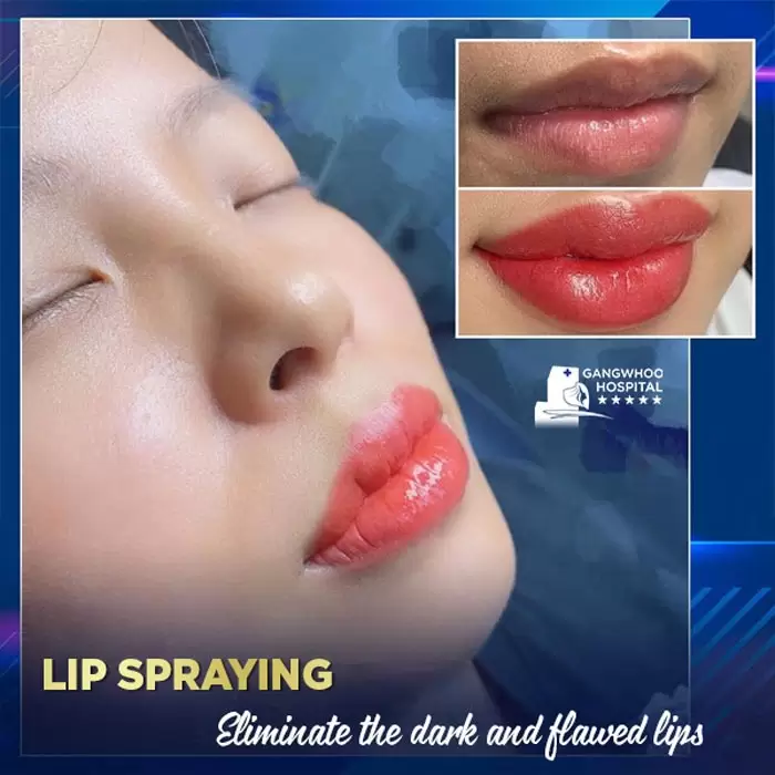 Dark Lip Lightening for Men & Women 2 TBG lip spraying 3