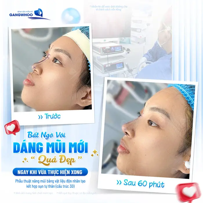 Phẫu Thuật Nâng Mũi Bằng Vật Liệu Độn Nhân Tạo Kết Hợp Sụn Tự Thân (Nâng Mũi Nanoform) 2 Bất ngờ dáng mũi mới quá đẹp ngay khi vừa thực hiện xong sau 60 phút góc nghiêng đã cao đẹp xuất sắc