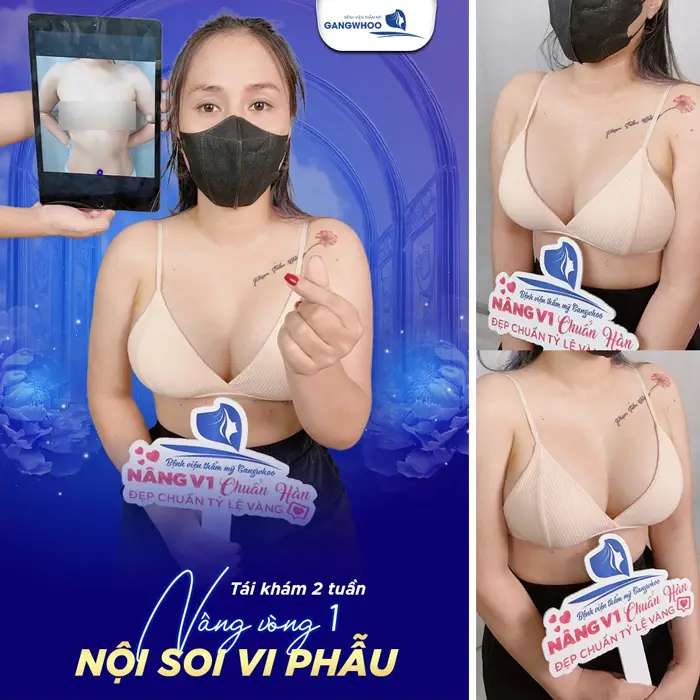 bau nguc cang dep sau nang nguc noi soi vi phau