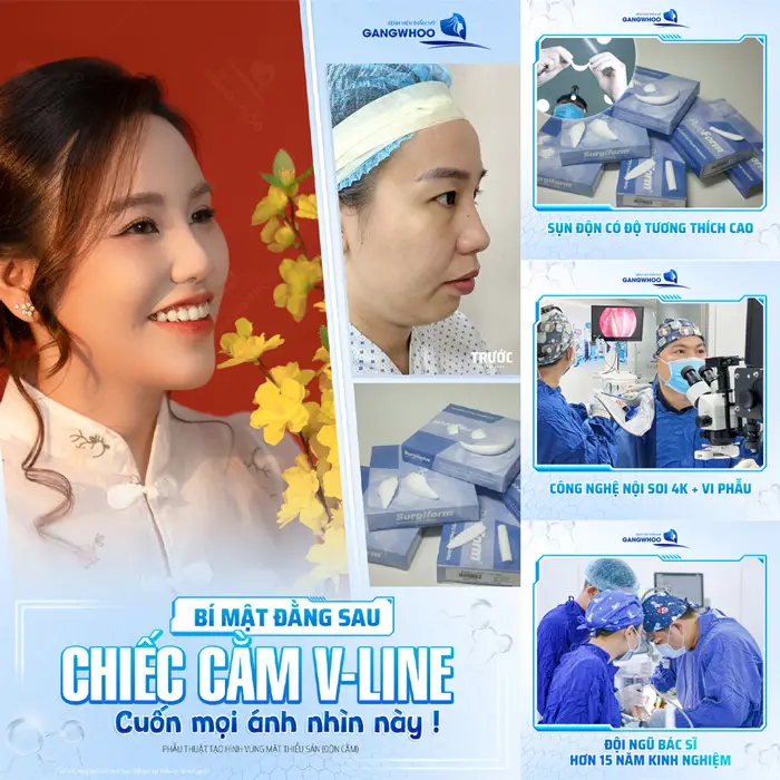 Cằm V Line đẹp chuẩn cuốn hút sau 1 tháng thực hiện với quy trình chuẩn hóa và an toàn tại BVTM Gangwhoo