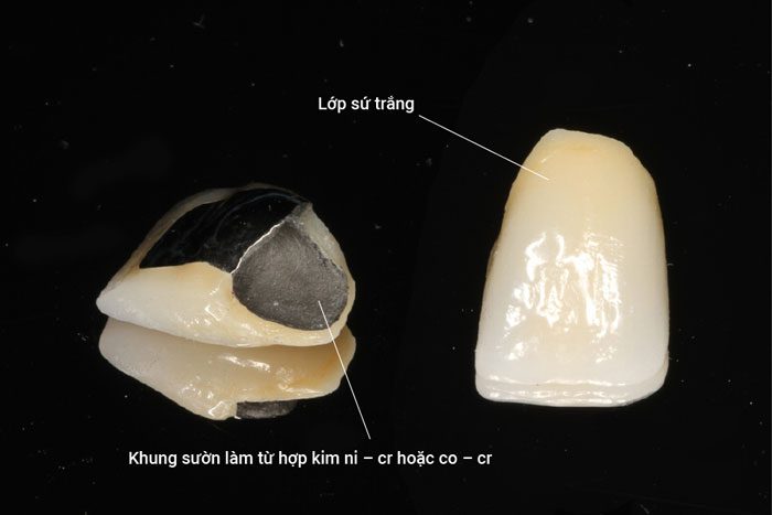 Hình ảnh Răng sứ kim loại