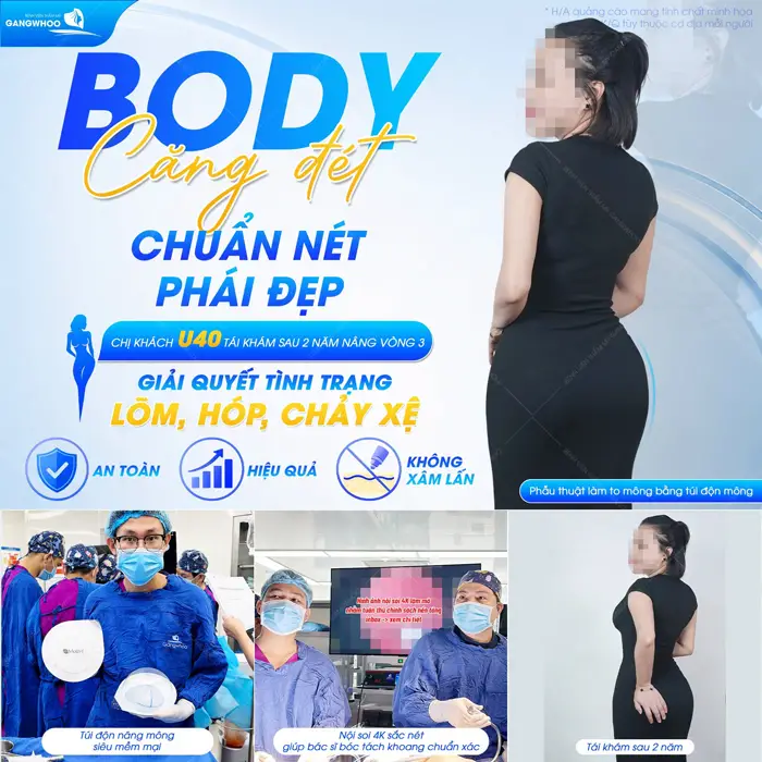 Body căng đét chuẩn nét phái đẹp chị khách U40 tái khám sau 2 năm nâng vòng 3 body đẹp xuất sắc