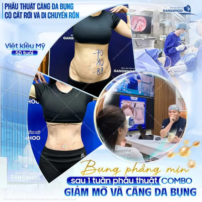 Cắt Da Thừa Bụng Và Tạo Eo Thon Cho Dáng Thon Thả "Nuột Nà" 1 Phẫu thuật căng da bụng có cắt rời và di chuyến rốn bụng phẳng mịn giảm mỡ nhanh chỉ sau 1 tuần