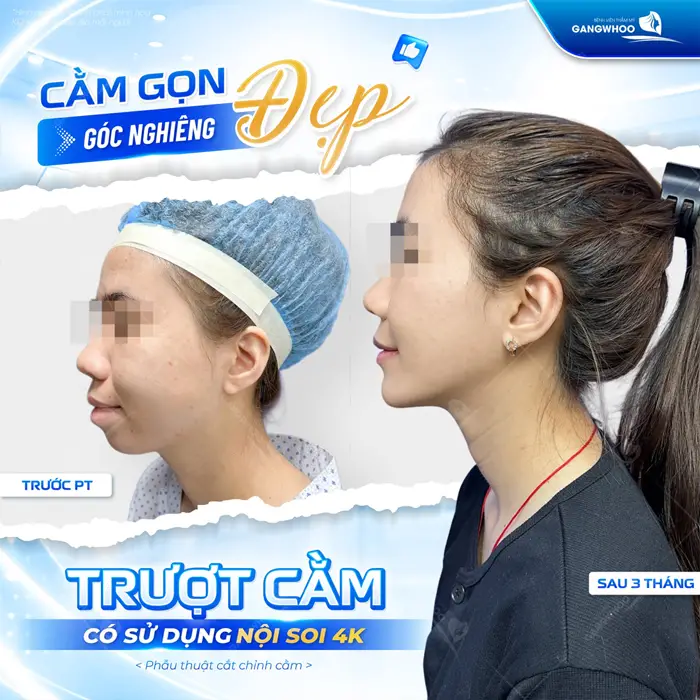 Cằm gọn góc nghiêng đẹp trượt cằm có sử dụng nội soi 4K khôi phục lại diện mạo hài hòa cho gương mặt