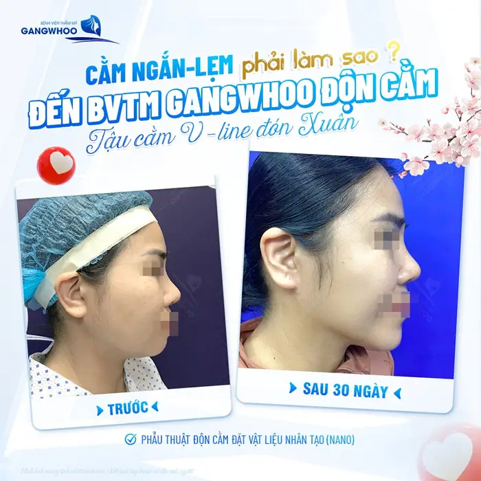 Cằm lẹm, cằm ngắn cũng đẹp xuất sắc sau 30 ngày thực hiện tại bệnh viện thẩm mỹ Gangwhoo 