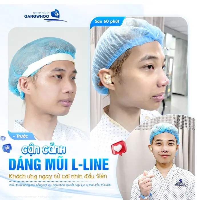 Cận cảnh dáng mũi  L Line được nhiều khách hàng yêu thích hiện nay