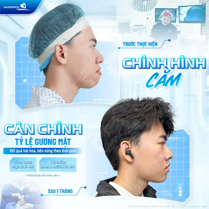 Cân chỉnh tỷ lệ gương mặt kết quả hài hòa bền vững theo thời gian