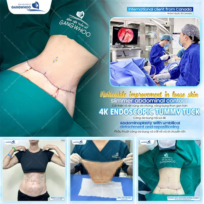 Cắt Da Thừa Bụng Và Tạo Eo Thon Cho Dáng Thon Thả "Nuột Nà" 5 Căng da thừa vùng bụng ứng dụng công nghệ nội soi 4K tự tin khoe eo thon bụng phẳng đẹp nuột nà và phẳng mịn