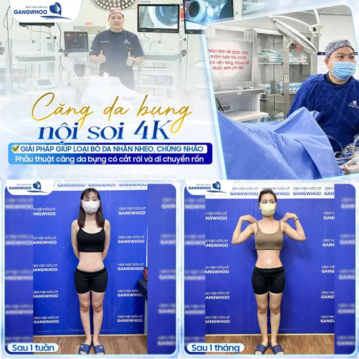 Căng da bụng nội soi 4K giải pháp giúp loại bỏ da nhăn chùng nhão hiệu quả