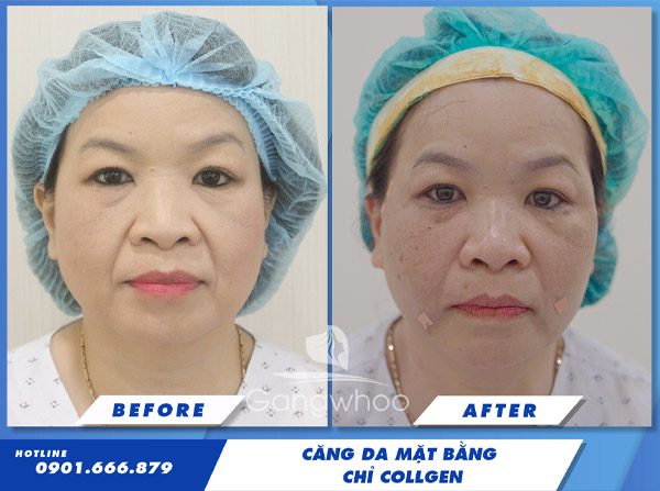Images of our customers before & after facelift with Doctor Phung Manh Cuong