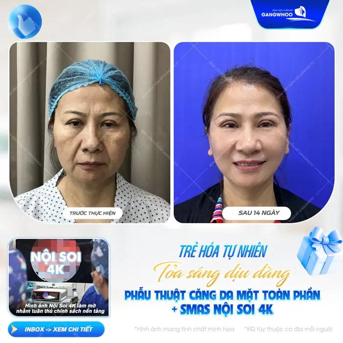 Trẻ hóa làn da đẹp tự nhiên sau 14 ngày  bất ngờ trước diện mạo xinh đẹp, rạng rỡ