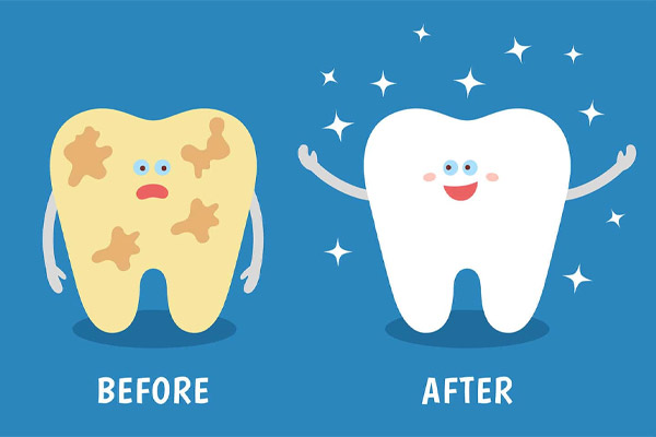 Cạo vôi răng cùng đáng bóng răng giúp bảo vệ sức khỏe răng miệng