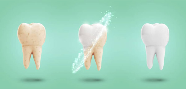Lấy cao răng không gây hại cho răng