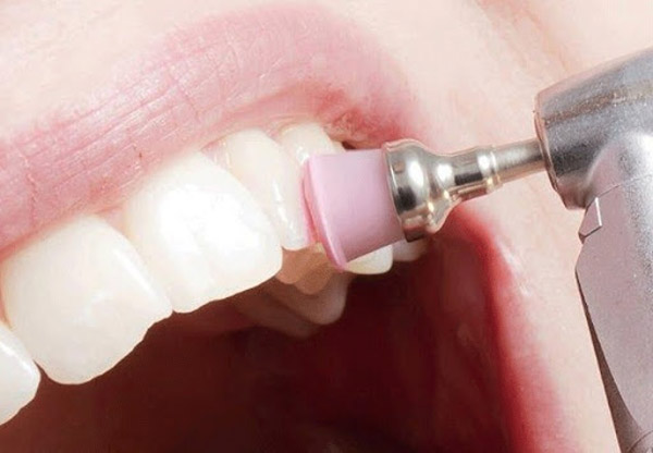 Lấy cao răng giúp phòng ngừa men răng bị hư hỏng nặng