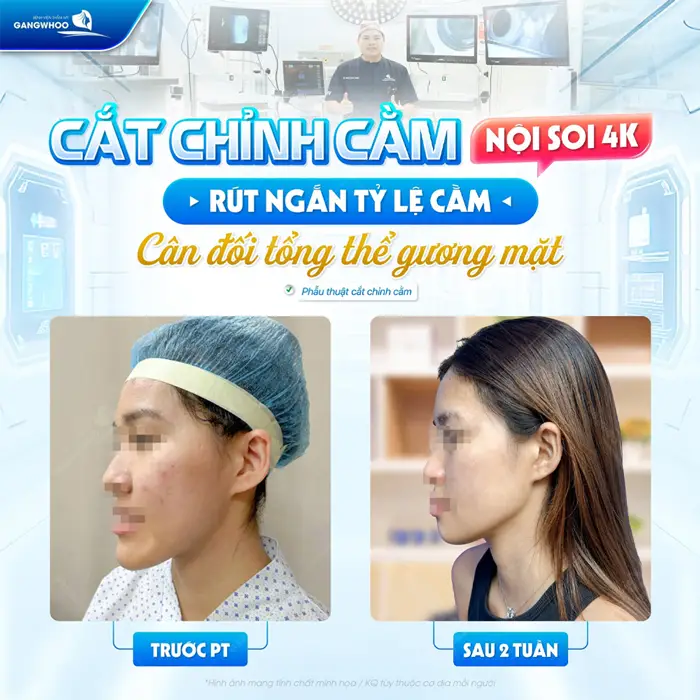 Gọt Góc Hàm, Cành Ngang, Góc Cằm Vuông Cho Mặt Thanh Tú 3 Cắt chỉnh cằm nội soi 4K rút ngắn tỷ lệ cằm cho gương mặt thêm cân đối và hài hòa hơn