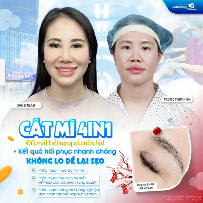 Cắt Mắt 2 Mí Có Để Lại Sẹo Không? Hướng Dẫn Chăm Sóc 2 Cắt mí 4In1 đối mắt trẻ trung và đầy cuốn hút mắt đẹp nhanh hồi phục mà không để lại sẹo xấu sau phẫu thuật