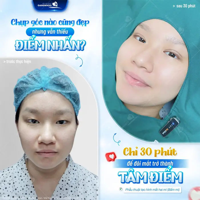 Cắt Mắt 2 Mí Có Để Lại Sẹo Không? Hướng Dẫn Chăm Sóc 3 Chỉ sau 30 phút đôi mắt trở thành tâm điểm của sự chú ý với diện mạo tươi tắn và trẻ trung hơn