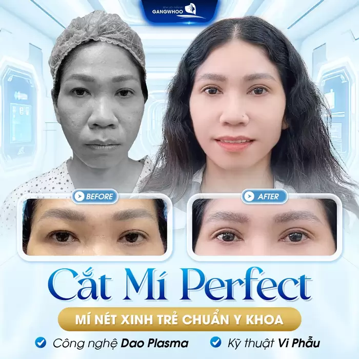 Bảng Giá Phẫu Thuật Thẩm Mỹ Làm Đẹp Tại Bệnh Viện Thẩm Mỹ Gangwhoo 2 cat mi perfect mi net xinh tr chuan y khoa