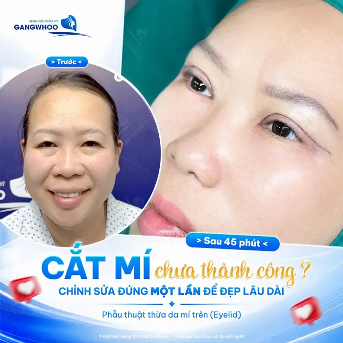 Kết quả sau 45 phút cắt mí đẹp thành công chỉ cần làm 1 lần là đủ xinh đẹp