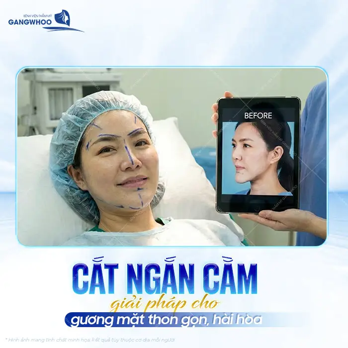 Cắt ngắn cằm giải pháp toàn diện cho gương mặt thêm thon gọn, hài hòa