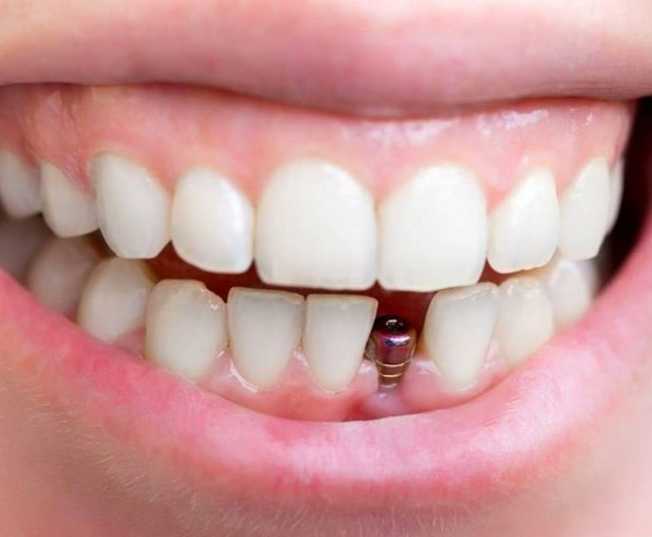 Kỹ thuật tạo răng giả an toàn