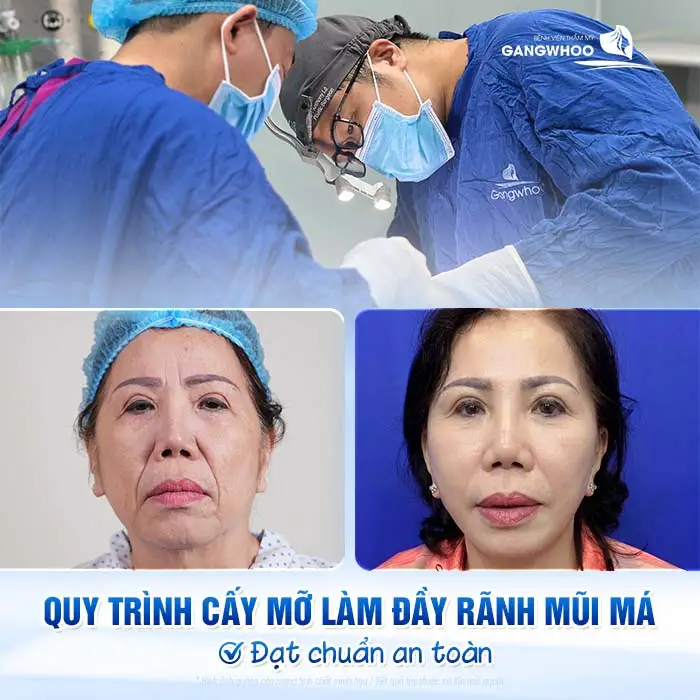 Quy trình cấy mỡ làm đầy rãnh mũi má đạt chuẩn an toàn do bác sĩ chuyên môn thực hiện