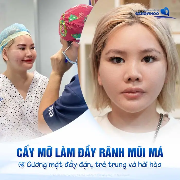 Cấy mỡ má làm đầy rãnh mũi má gương mặt đầy đặn, trẻ trung và hài hòa hơn sau thực hiện