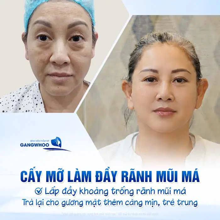 Cấy mỡ làm đầy rãnh mũi má lấp đầy khoàng trống rãnh mũi má trả lại cho gương mặt thêm căng mịn, trẻ trung