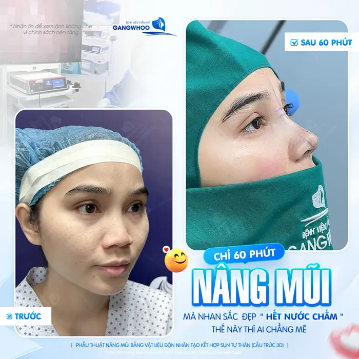 Phẫu Thuật Nâng Mũi Bằng Vật Liệu Độn Nhân Tạo Kết Hợp Sụn Tự Thân (Nâng Mũi Nanoform) 9 Chỉ sau 60 phút mà nhan sắc đẹp xuất sắc và đẹp thăng hạng hơn thấy rõ