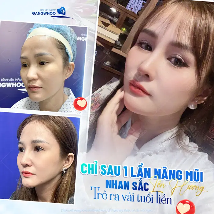 Chỉ 1 lần nâng mũi nhan sắc lên hương trẻ ra vài tuổi diện mạo đẹp chuẩn đầy cuốn hút