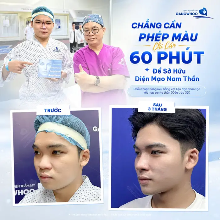 Phẫu Thuật Nâng Mũi Bằng Vật Liệu Đôn Nhân Tạo Kết Hợp Sụn Tự Thân (Nâng Mũi Surgiform) 1 Kết quả sau 60 phút sở hữu diện mạo nam thần gương mặt thêm hài hòa và đẹp rõ nét chuẩn nét soái ca