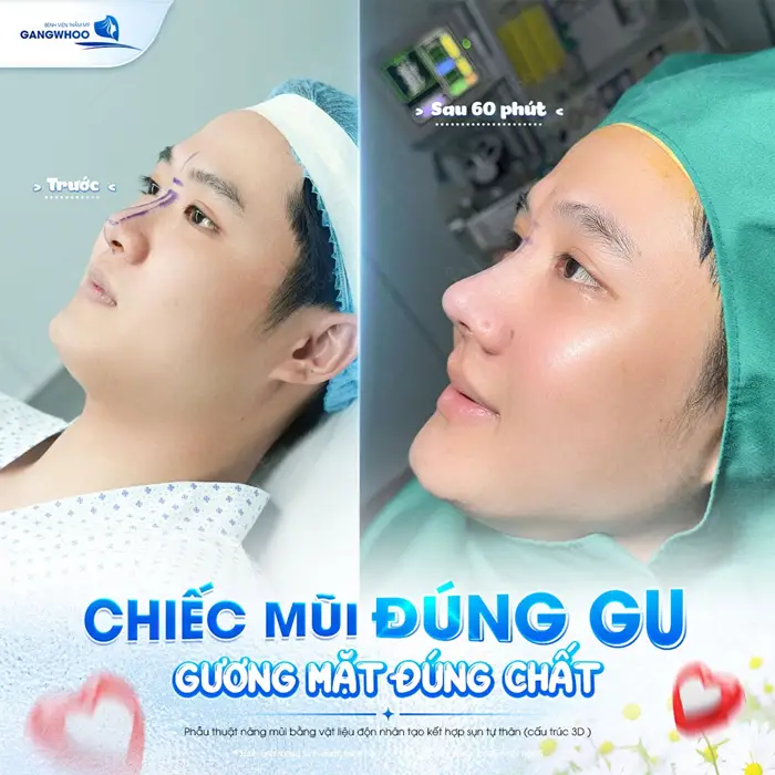 Chiếc mũi đúng gu gương mặt đúng chất sau 60 phút phẫu thuật tự tin hơn với dáng mũi đẹp chuẩn tỷ lệ