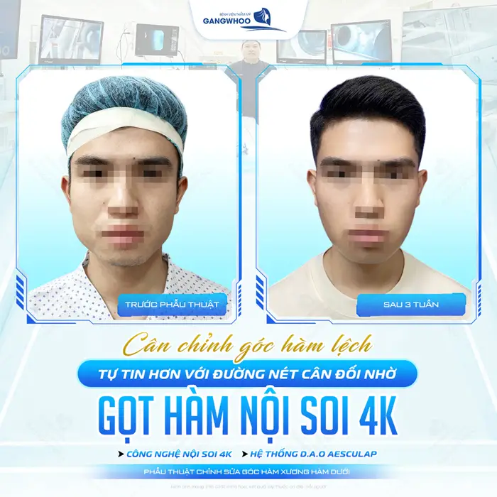 Gọt Góc Hàm, Cành Ngang, Góc Cằm Vuông Cho Mặt Thanh Tú 5 Cân chỉnh góc hàm lệch tự tin hơn với đường nét cân đối nhờ gọt hàm nội soi 4K