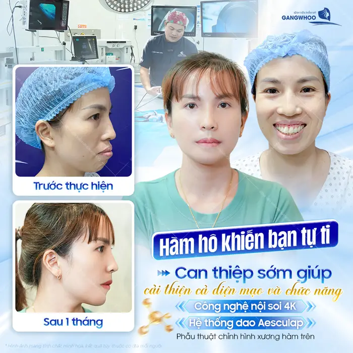 Tạm biệt hàm hô khiến bạn tự ti sau khi phẫu thuật can thiệp ứng dụng công nghệ hiện đại diện mạo đã hoàn toàn thay đổi