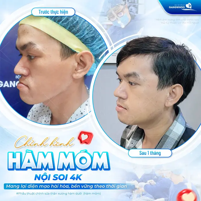 Chỉnh Hàm Hô Móm Có Nguy Hiểm Không? Quy Trình An Toàn 9 Chỉnh hình hàm móm nội soi 4K mang lại diện mạo hài hòa và bền vững theo thời gian