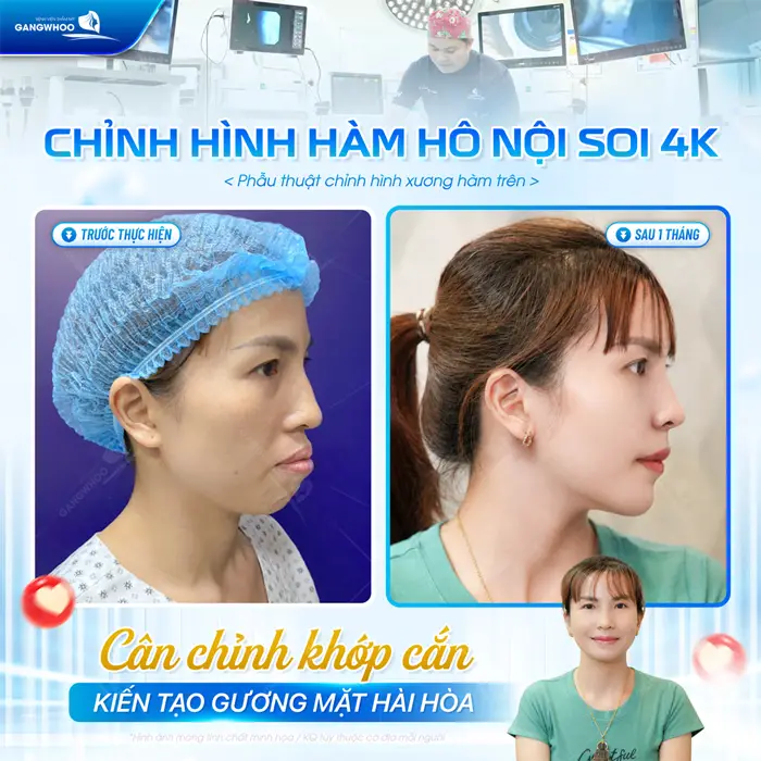 Chỉnh hình hàm hô nội soi 4K cân chỉnh khớp cắn kiến tạo gương mặt hài hòa