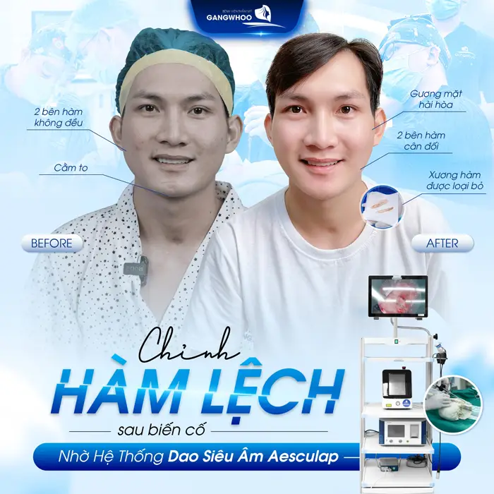 Trượt Cằm V-Line Nội Soi 4K - Quy Trình Và Những Lưu Ý 16 trượt cằm