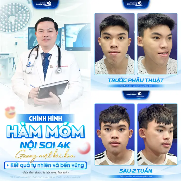 Chỉnh hàm móm ứng dụng công nghệ nộip soi hiện đại gương mặt thêm hài hòa, kết quả đẹp tự nhiên và bền vững dài lâu 