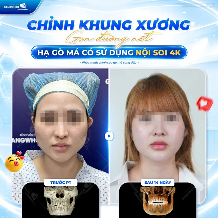 Chỉnh xương gò má gọn đường nét sau phẫu thuật diện mạo trẻ trung, hài hòa với đường nét thanh thoát 